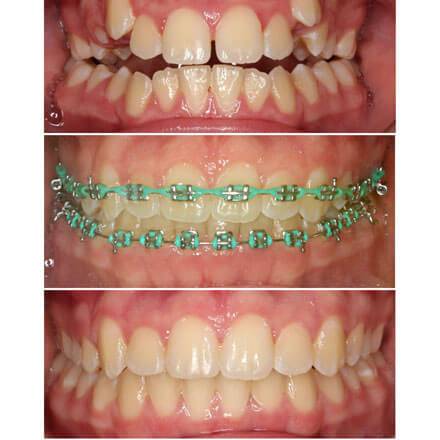 palatal expander